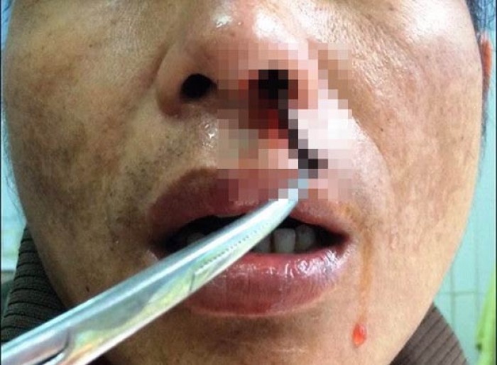 gap con dia dai 5 cm trong mui mot nguoi dan ong cotu