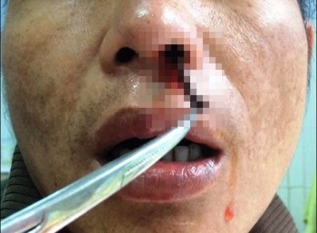 Con đỉa dài 5cm trong mũi người đàn ông Cơ Tu