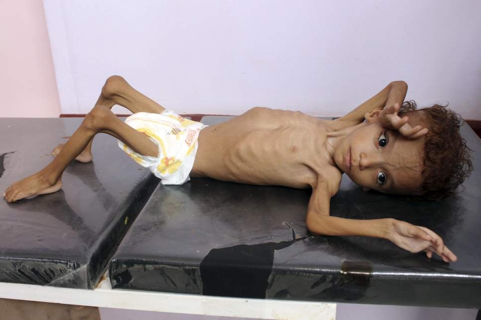 nam trieu tre em o yemen co nguy co doi dien nan doi