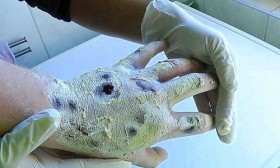 Krokodil - ma túy "ăn thịt người" kinh khủng nhất