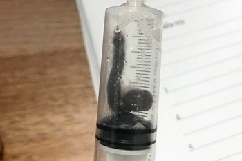 Hai con vắt ký sinh trong mũi cụ bà