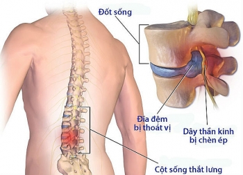 Thoát vị đĩa đệm: Khi nào cần phẫu thuật?