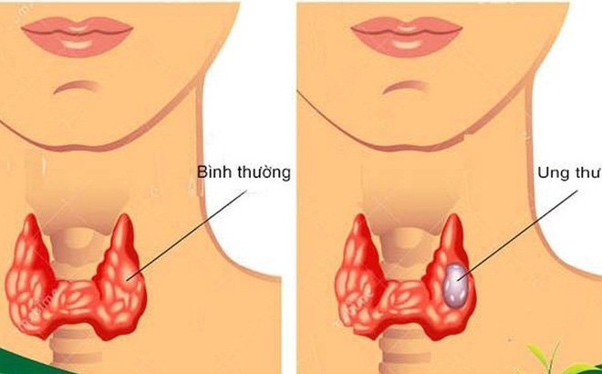 Phẫu thuật thành công khối ung thư tuyến giáp phức tạp
