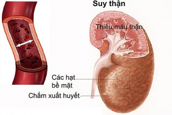 Bệnh thận mạn chiếm từ 10 - 14% dân số