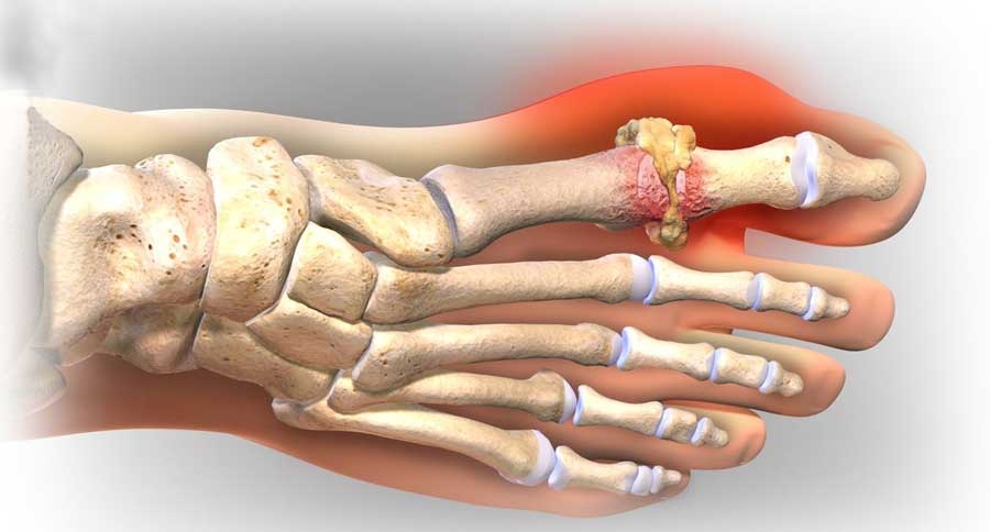 Gout không chỉ là bệnh của riêng nam giới