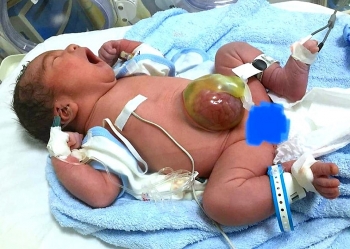 Sự phục hồi ngoạn mục của bé sơ sinh bị thoát vị rốn khổng lồ