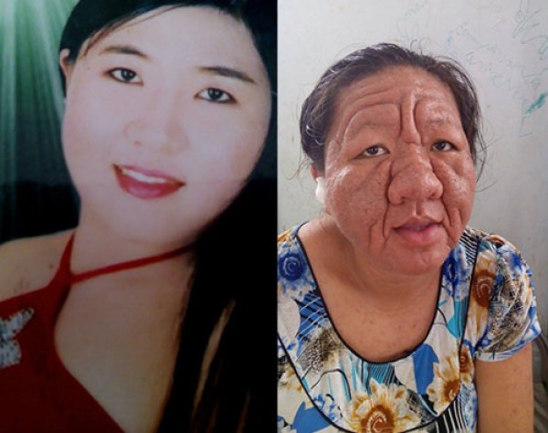 co gai hoa ba lao 70 tuoi vi my pham chua corticoid