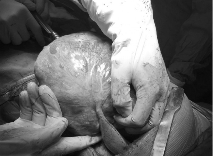 lay khoi u nang 26 kg trong khoang mang phoi benh nhan