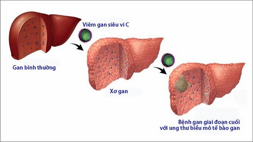 Việc sử dụng thuốc liên tục trong điều trị bệnh gan mạn là hết sức quan trọng 