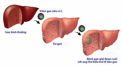Lưu ý sức khỏe với người mắc bệnh gan mạn tính trong dịch Covid-19