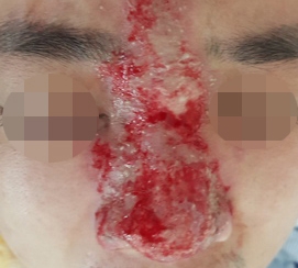 Mù mắt vì tiêm filler làm đẹp