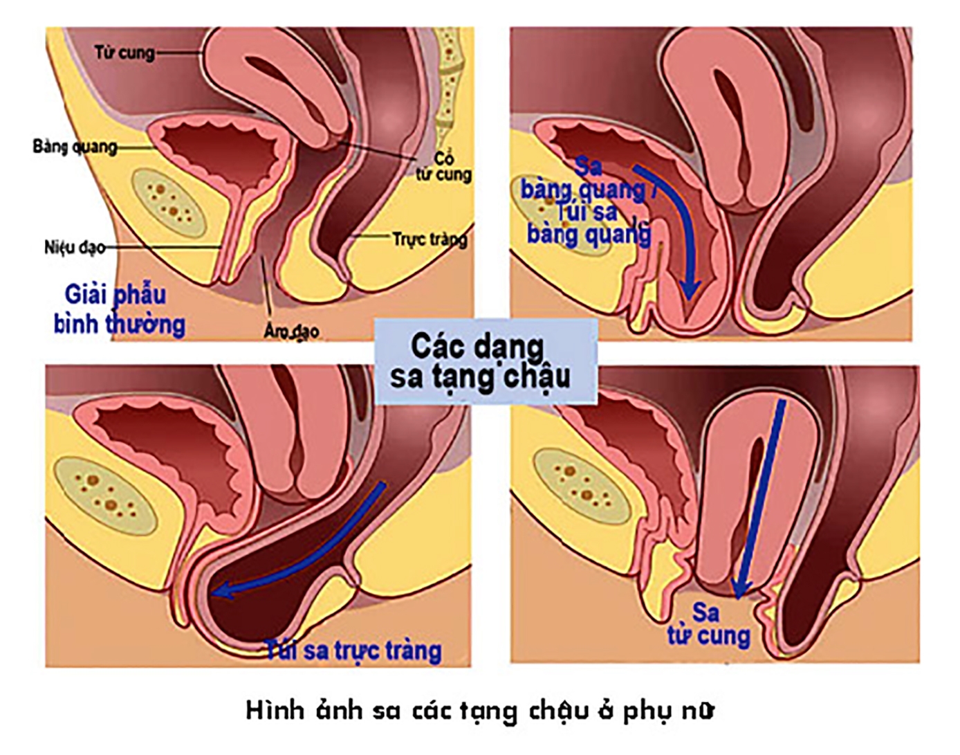 Sa tạng chậu - Bệnh lý gây nhiều mặc cảm cho phụ nữ
