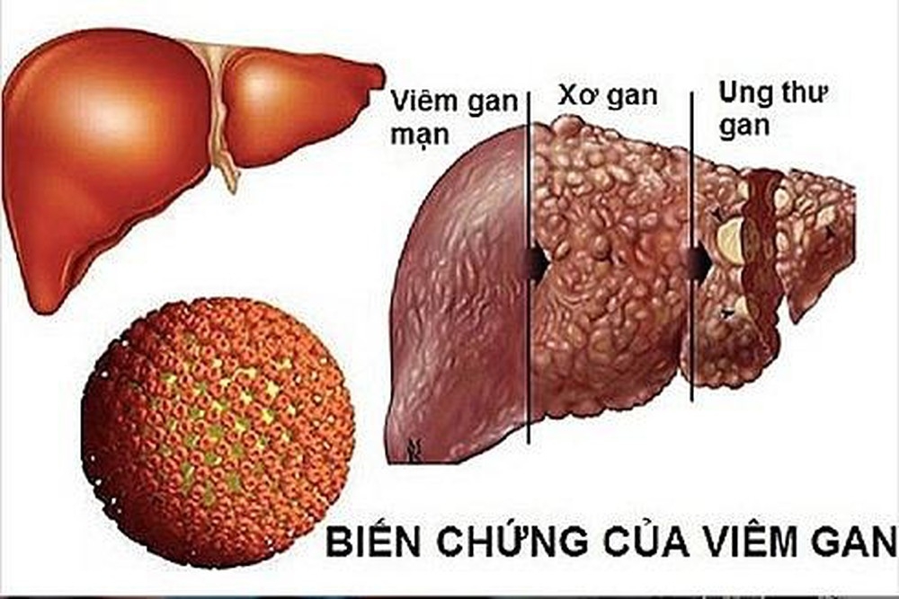 Tầm soát sớm ung thư tế bào gan