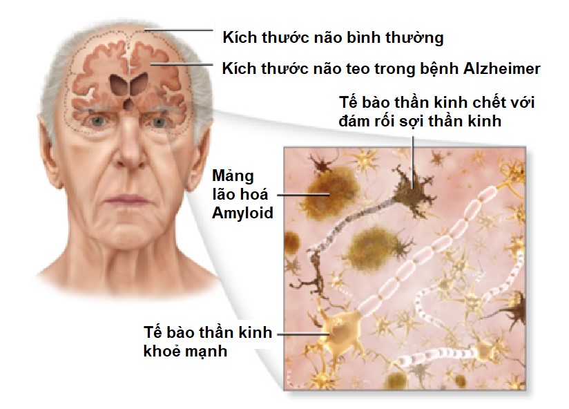 Công nghệ xét nghiệm máu giúp cảnh báo sớm bệnh Alzheimer