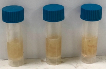 Bé gái bị nhiễm hai siêu vi khuẩn kháng thuốc