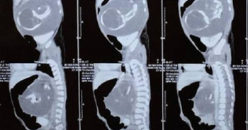 Bé trai chào đời mang theo người em song sinh… trong bụng