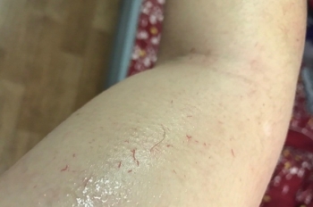 Người đàn ông đổ "mồ hôi máu" lần đầu tiên ghi nhận tại Việt Nam