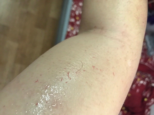 Người đàn ông đổ mồ hôi máu lần đầu tiên ghi nhận tại Việt Nam - 4 Người đàn ông đổ mồ hôi máu lần đầu tiên ghi nhận tại Việt Nam - 4