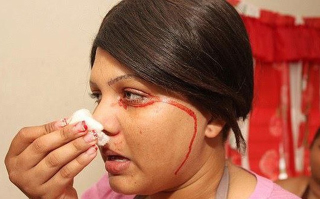 Người đàn ông đổ mồ hôi máu lần đầu tiên ghi nhận tại Việt Nam - 5 Người đàn ông đổ mồ hôi máu lần đầu tiên ghi nhận tại Việt Nam - 5