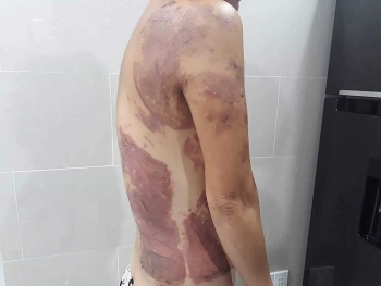 Người phụ nữ tạt chảo dầu sôi vào hàng xóm mong được bỏ qua