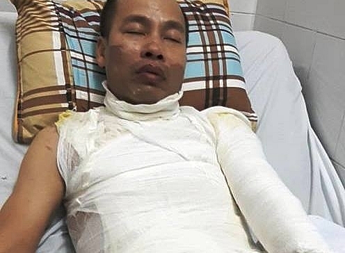 Bé gái 9 tuổi hoảng loạn chứng kiến bố bị tạt axit ngay trước mặt