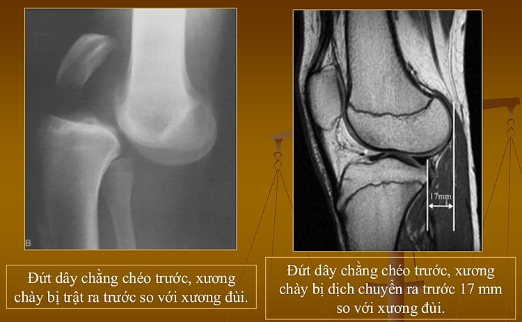 Đứt dây chằng chéo trước - ác mộng của giới cầu thủ