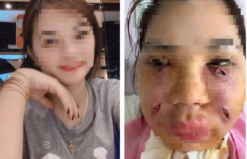 Sốc: Cô gái xinh đẹp mặt biến dạng, chi chít lỗ rò mủ sau 2 mũi tiêm mỡ tự thân