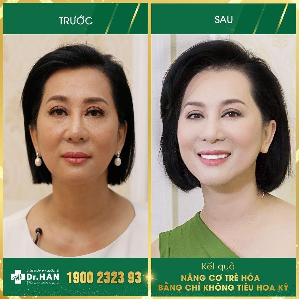 Nâng cơ trẻ hóa bằng chỉ không tiêu Hoa Kỳ- Bước tiến vượt trội trong ngành thẩm mỹ không phẫu thuật