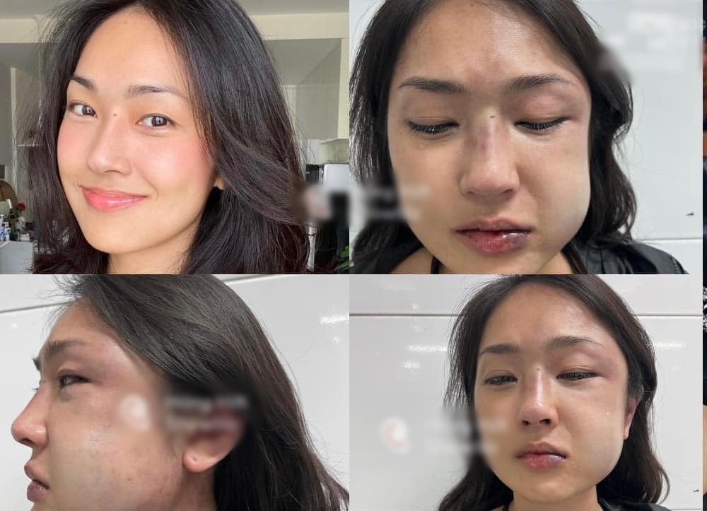 Nghi ngờ bạn trai lăng nhăng, Misoa bị người yêu "tác động vật lý"