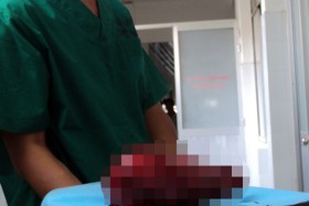 Phẫu thuật lấy khối u xơ tử cung hơn 3 kg