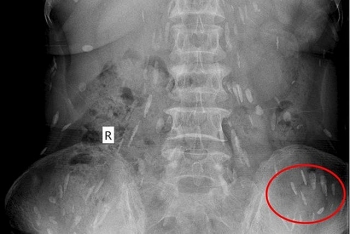 Một phụ nữ ở Nghệ An bị sán lá gan ký sinh hầu hết bộ phận trong cơ thể