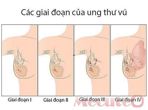 ung thu vuphat hien som se dieu tri khoi