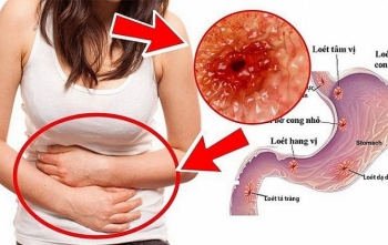 Bệnh viện Hữu nghị Việt Đức khám và tư vấn miễn phí bệnh dạ dày