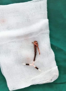 Vòng tránh thai lạc vào… bàng quang