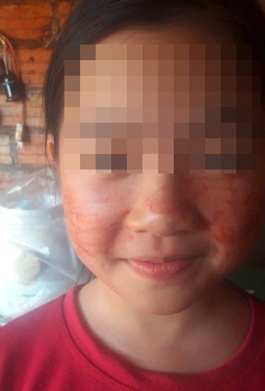 Bé gái đổ "mồ hôi máu" khi căng thẳng