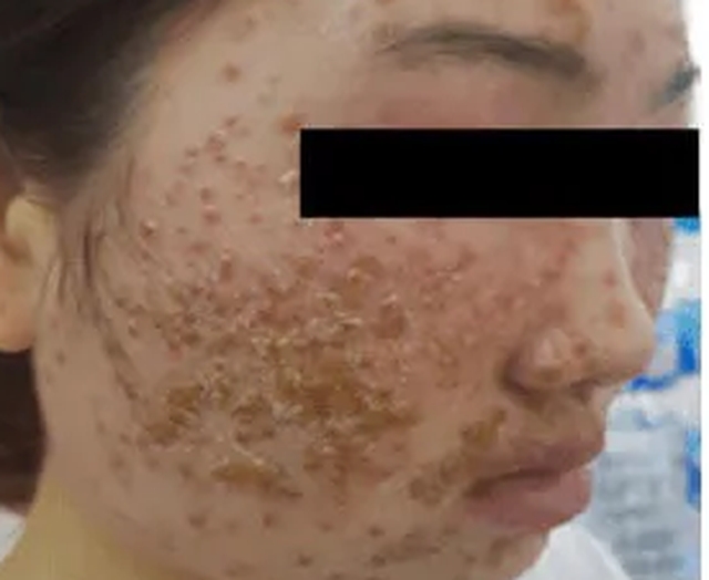 Nhập viện vì đẹp da bằng loại bột quảng cáo trên mạng