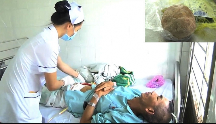 mot benh nhan co vien soi bang quang nang 500g