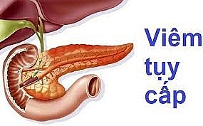Một người nguy kịch vì viêm tụy cấp hoại tử do uống rượu