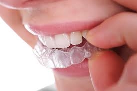 Những ai nên tẩy trắng răng?