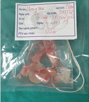 Phẫu thuật lấy cả ổ nang sán trong não bệnh nhân