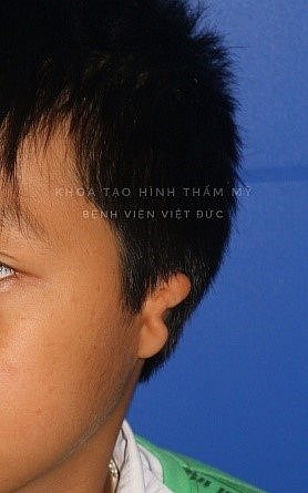 bv huu nghi viet duc phau thuat thanh cong ky thuat tao hinh kho nhat tao hinh tai nho bang sun suon tu than