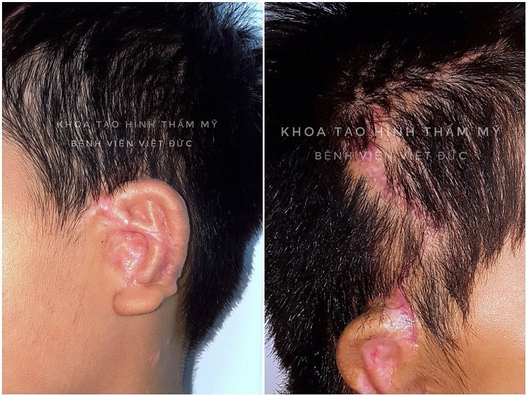 bv huu nghi viet duc phau thuat thanh cong ky thuat tao hinh kho nhat tao hinh tai nho bang sun suon tu than