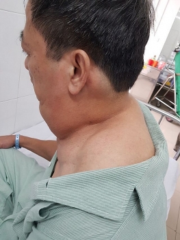 Bị u mỡ bao quanh cổ vì nghiện rượu